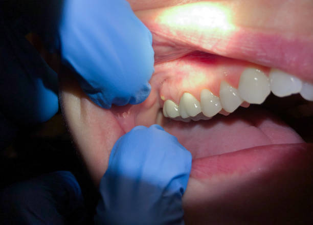 Best Emergency Dental Care for Broken or Chipped Teeth in Stratford, WI